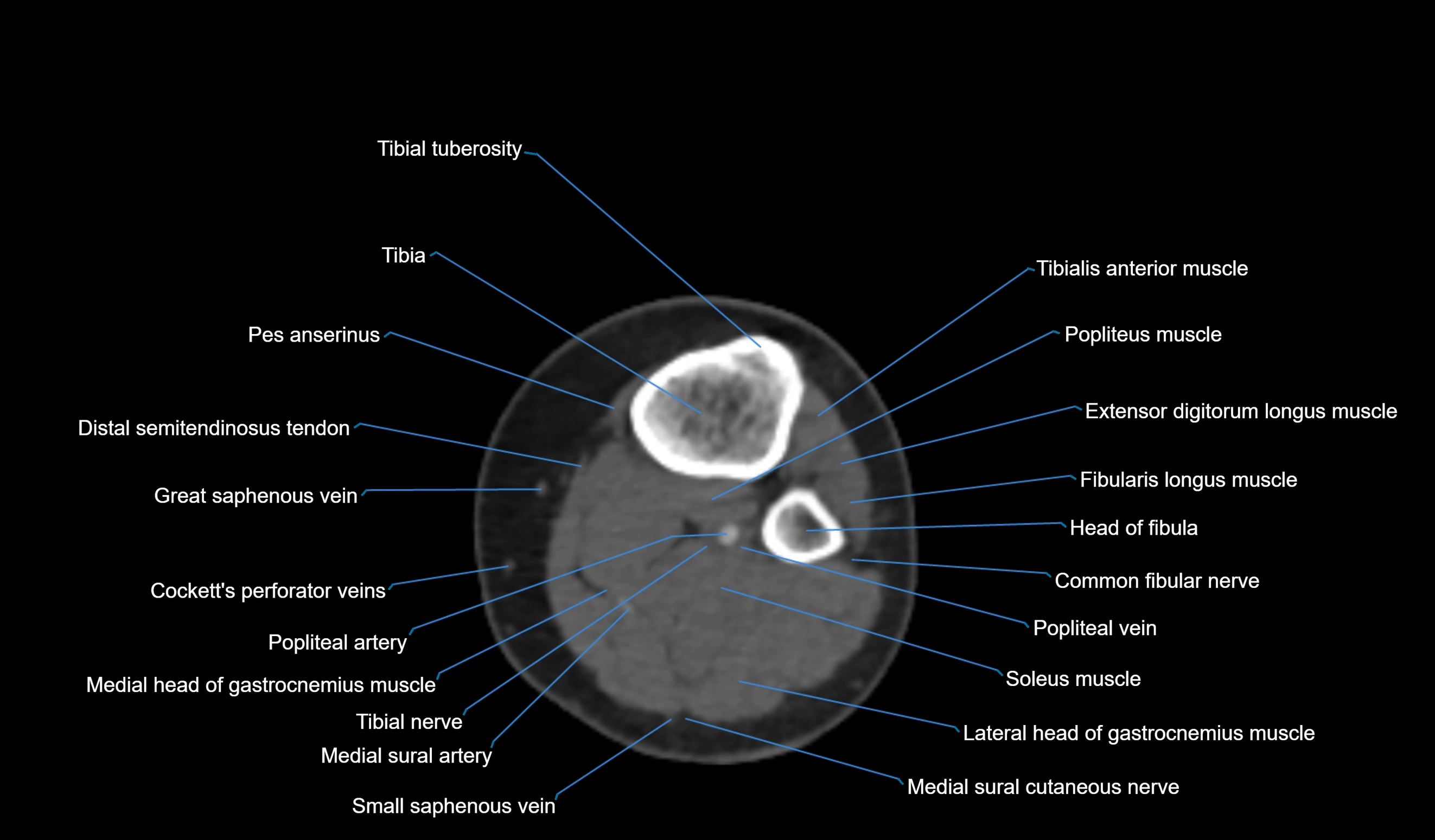 CT knee axial cross sectional anatomy labelled image-00050.webp
